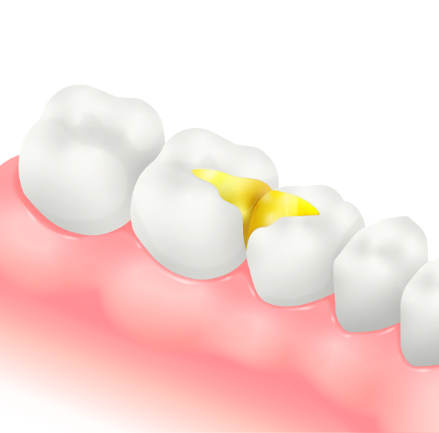 メタルインレー(銀色の金属素材)
